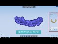 Shining 3D - Impression Scan with Bite Record