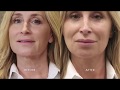 Tempsure 20 minute nonsurgical face lift