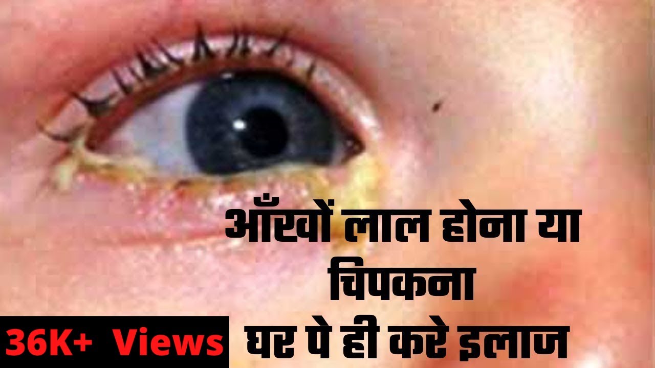 Aankho Ka Lal Hona Ya Aankh Aana SURBHI UTPAD YouTube