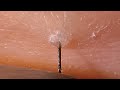 iPhoneで撮影した毛抜き動画・埋没毛抜きVrog【hair remove】