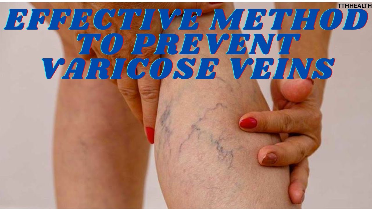 Effective method to prevent varicose veins - YouTube