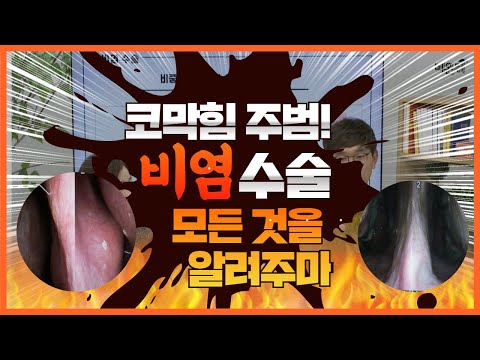 코막힘 주범! 비염은 수술하면 재발하는 데 뭐하려 해? 코 만랩이 알려주는 비염수술에 관한 모든 것