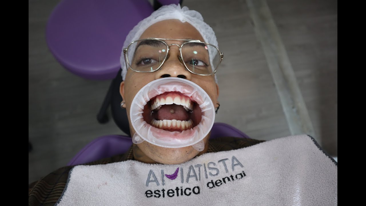 Getting Veneer's inside Tijuana for under 3k YouTube