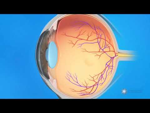 OVCR – Occlusion de la veine centrale de la rétine