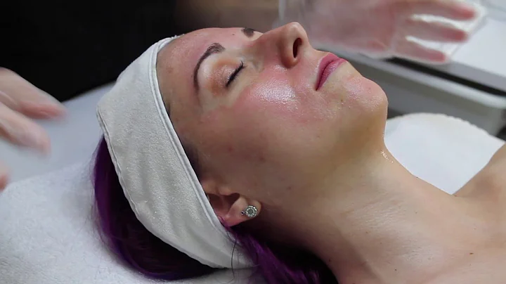 Full Lactic Peel Treatment