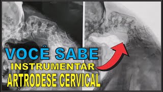 VOCÊ SABE INSTRUMENTAR ARTRODESE CERVICAL DE MASSA LATERAL / VIA POSTERIOR -Instrumentação Cirúrgica