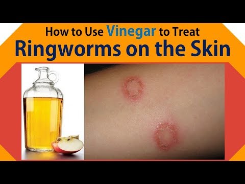 Apple Cider Vinegar Treatment Ringworm Treatment