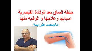 جلطة الساق بعد الولادة القيصرية أسبابها وعلاجها والوقاية منها. #دكتور_محمد_طرابيه