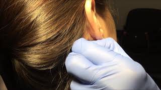video thumbnail for: Neck Cyst Excision 09/06/17