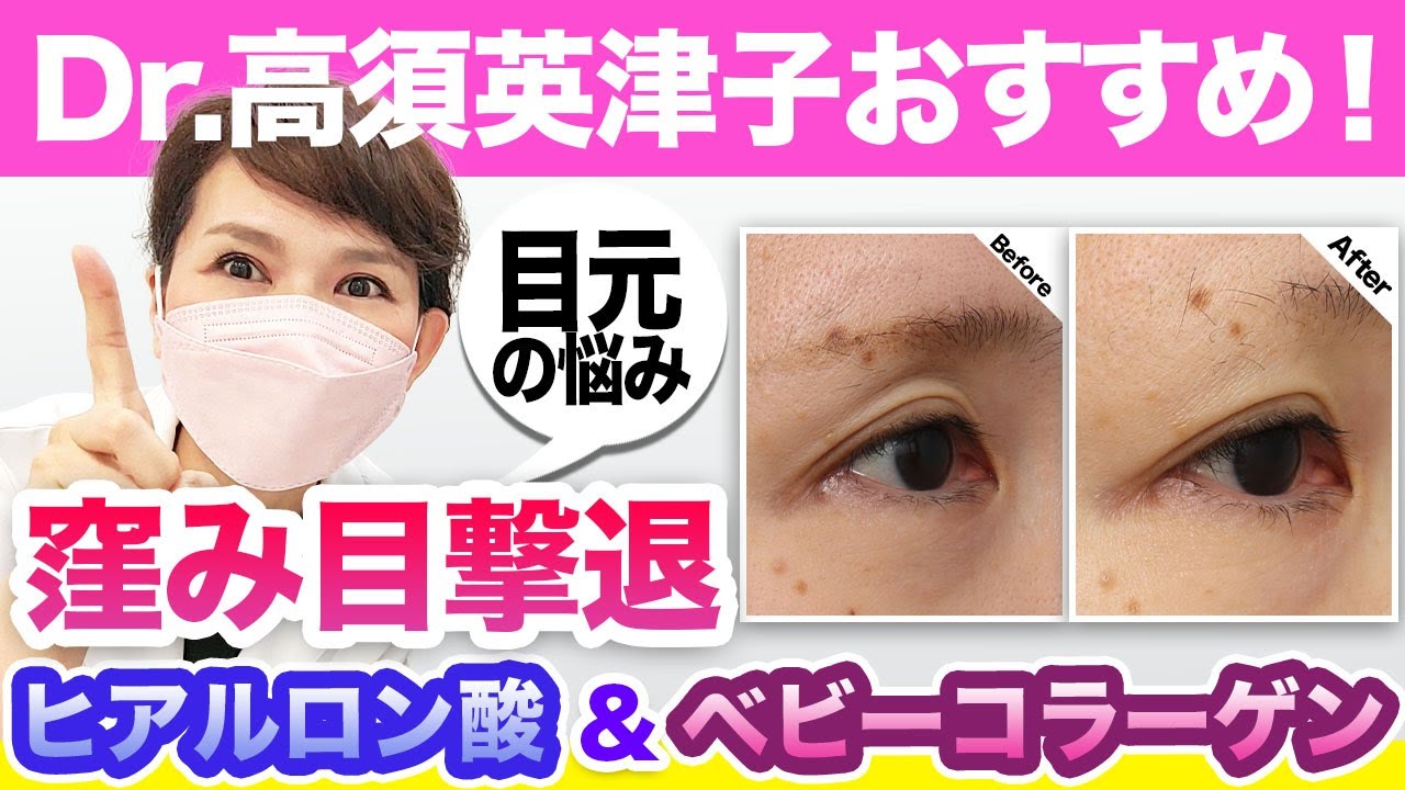 【目元の悩み】目の窪みとクマをヒアルロン酸とベビーコラーゲンで改善！【アンチエイジング】