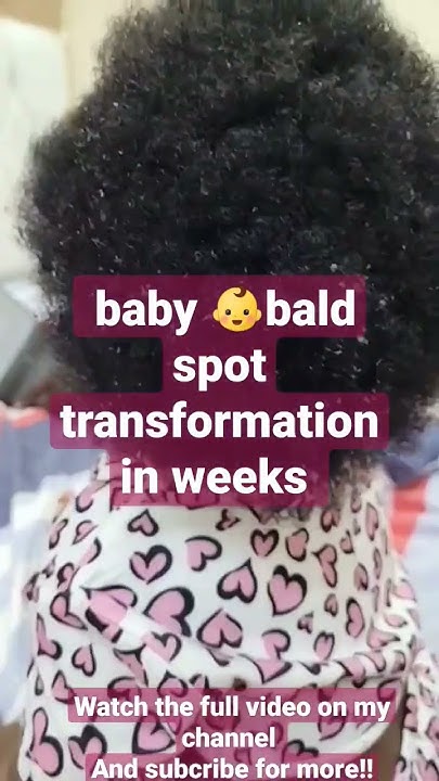 how-i-grew-my-baby-bald-spot-in-weeks-longhair-shorts-hairgrowth
