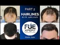 Hairlines by dr juan couto at fuexpert clinic  hair transplant clinic in madrid spain  part 2