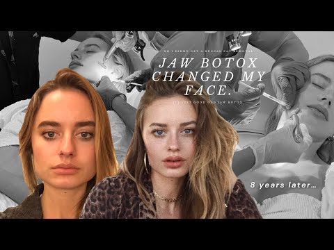 The truth on how I changed my face shape 🎀 ✨JAW BOTOX ✨🎀