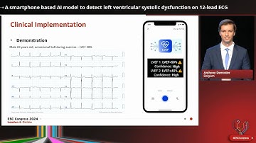 A smartphone-based AI model to detect left ventricular systolic dysfunction on ECG | ESC London 2024