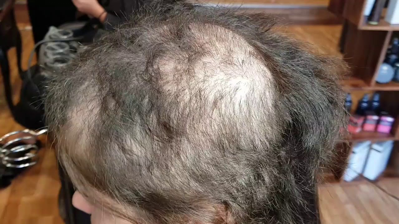 Trichotillomania HOW to COVER hair loss in 2019 "HAIR PULLING SOLUTION