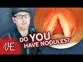 Do I Have Nodules? | Nodes on Vocal Cords | #DrDan ��  (Aud.Tewfiq Siliman Herini - Erbil-Kurdistan)) tewfiqsiliman@yahoo.com 009647504485973