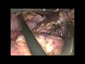 Lap assisted distal pancreatectomy dr nilesh chordiya