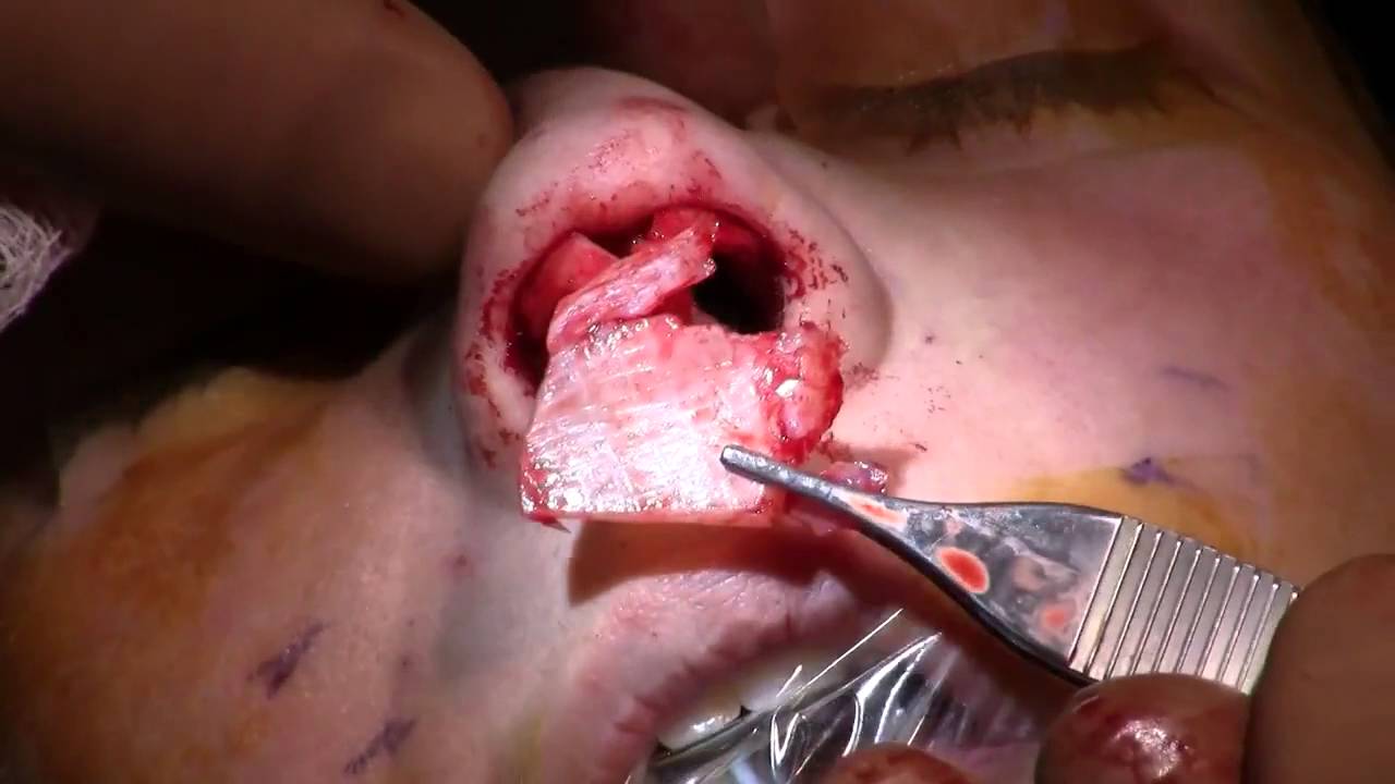 Rhinoplasty Surgery (Christina) (Part 2) by Dr. Miller