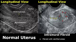 Uterus Ultrasound Normal Vs Intramural Fibroid Images | Uterine Leiomyomas USG Cases