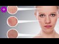 Get Rid Of All Skin Problems | Rife Frequency For Acne, Allergy, Pimples, Eczema, All Skin Disease