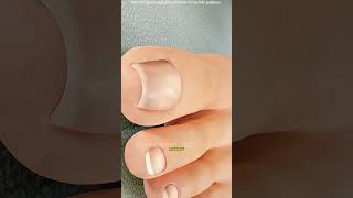 Surgery for ingrown toenails #epic #science #epicmusicword #3danimation #motivation #facts #faceturn