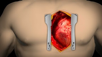 Heart Bypass Surgery | Step by step