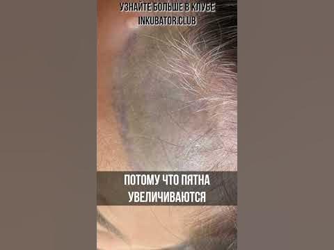 Витилиго и камуфляж - YouTube