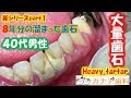 上尾 歯医者 8年分の歯石取り tartar 去除牙垢 กำจัดตาด