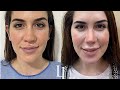 Rinoplastia Dr Jaimes 07/12/23