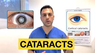 Cataracts Simplified: Symptoms, Causes, and Treatments | Dr Neo Mavris