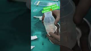 Urinary Disorder Turp Surgery Uro Surgery