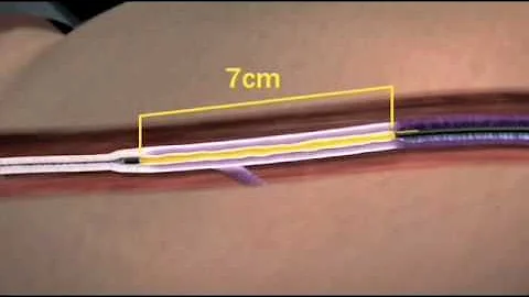 The Closure Procedure - Sonora Vein Center