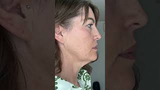 You won t believe Jodie s transformation just 3 weeks after surgery