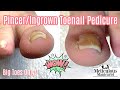 👣HOW TO REVERSE AND CURE PINCER TOENAILS 👣