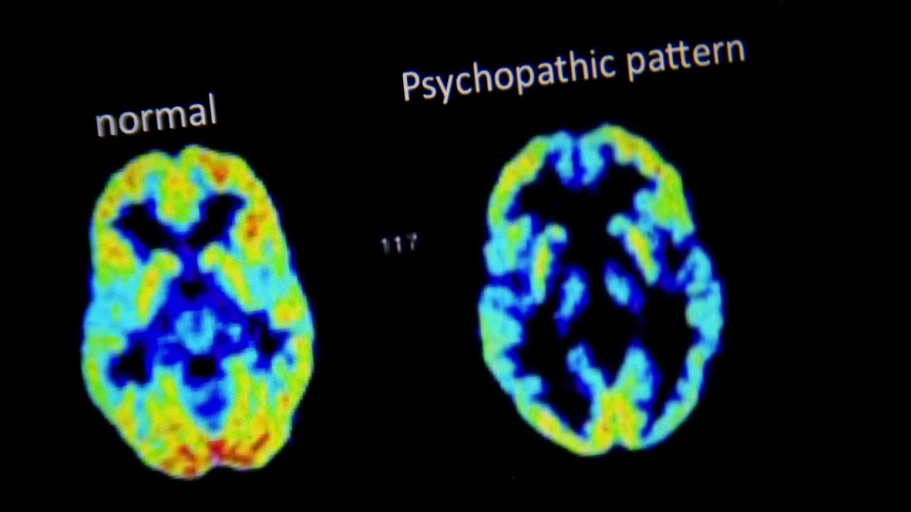 Image result for sociopath brain vs normal brain"