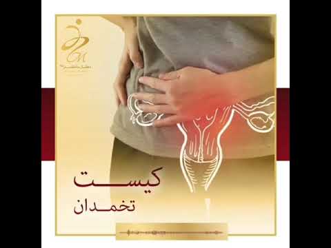 علائم کیست تخمدان و راه های درمان آن