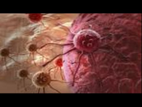 Wideo: Włókniaki Tkanek Miękkich - Przyczyny, Rodzaje, Objawy I Leczenie Mięśniaków Pooperacyjnych