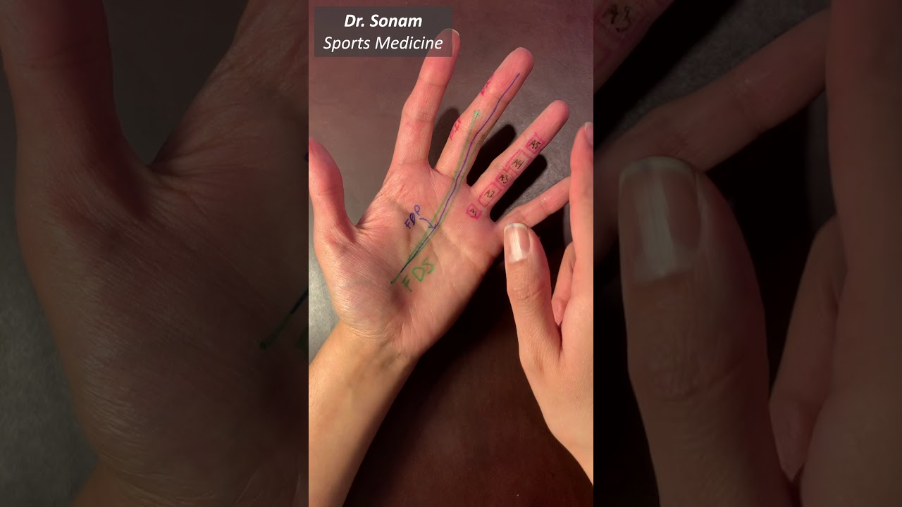 What is an A2 pulley injury (Climbers Finger) 