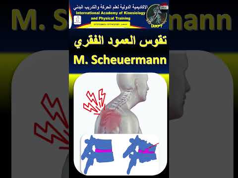 هذا المرض يصيب الناس بفترة البلوغ ويسبب اضرار جسيمة تعرفوا عليه وتخلصوا من عواقبه
