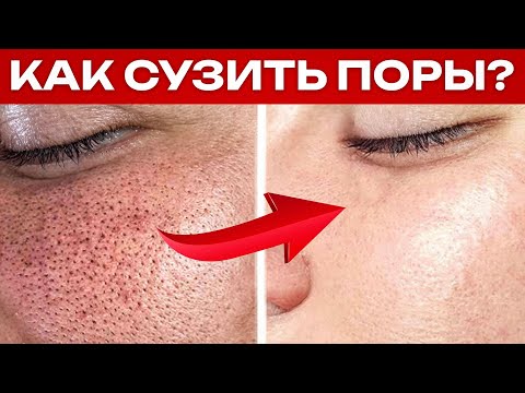 Как ИЗБАВИТЬСЯ от РАСШИРЕННЫХ ПОР в домашних условиях? / САМЫЙ ДЕЙСТВЕННЫЙ СПОСОБ