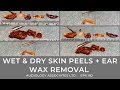 WET & DRY SKIN PEELS + EAR WAX REMOVAL - EP 182