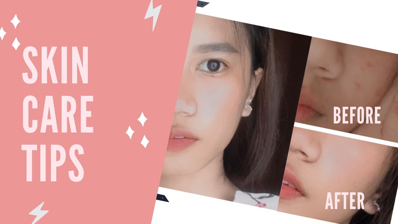 PAANO MAWALA ANG PIMPLES IN JUST 2 WEEKS? | SKIN CARE ROUTINE (VLOG #6) | ANNE TIBIO