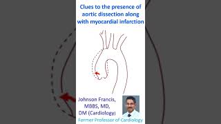 Clues to the presence of aortic dissection along with myocardial infarction