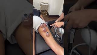 Cupping For Hamstrings Injury Sprain Strain Pain Tightness By Best Chiropractor In Beverly Hills