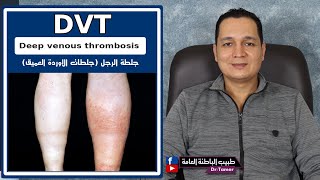 DVT deep venous thrombosis / جلطات الاوردة العميقة  جلطة الرجل
