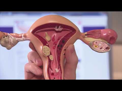 Video: Symptome von Uterusmyomen