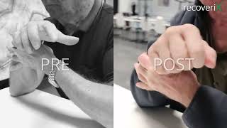 Before/After recoveriX - stroke - FFX FEX - ST15
recoveriX is measuring EEG activity while a patient imagines a hand or foot movements. Once recoveriX detects a motor imagination, it triggers a functional electrical stimulation of the limb so that the limb performs a real movement. Here you can see the improvement in the hand movement of the stroke-affected hand.
Learn more about this treatment: https://recoverix.com/ Before/After recoveriX - stroke - FFX FEX - ST15