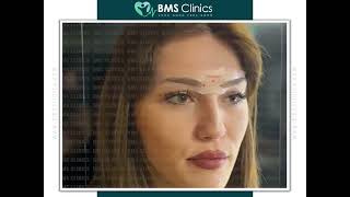 زراعة الحواجب في تركيا   hair Transplant  - BMS Clinics