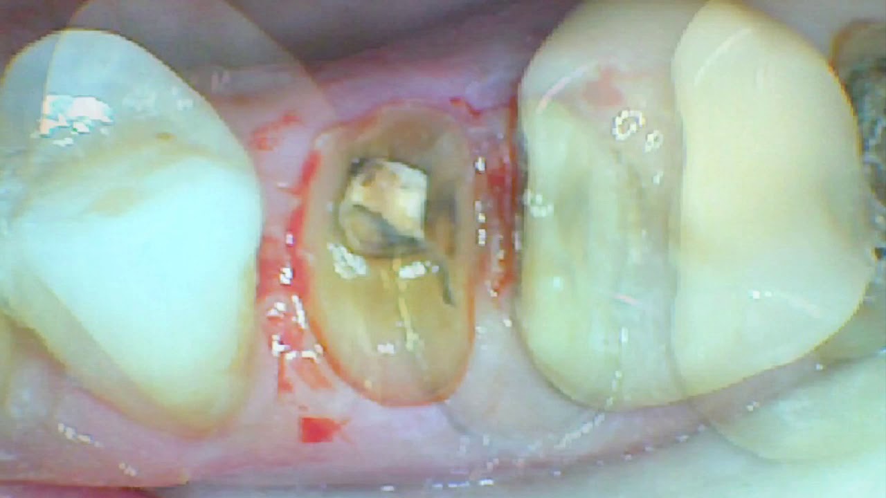 CRACKED TOOTH CROWN COSMETIC DENTIST YouTube