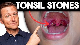 Tonsil Stones Removing The Deeper Cause